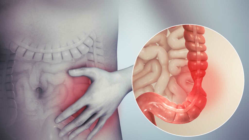 Cada 19 de mayo, se conmemora el Día Mundial de la Enfermedad Inflamatoria Intestinal