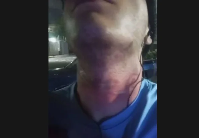 Joven motociclista casi muere degollado luego de colapsar una guaya en la avenida 3 con Universidad